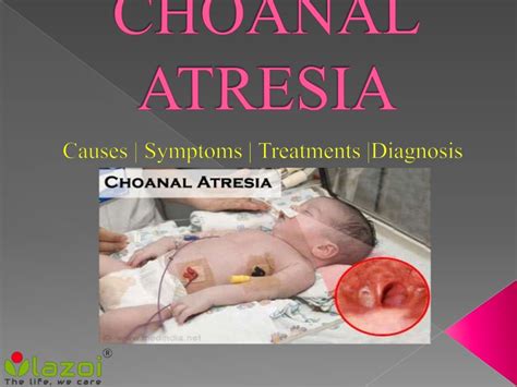 Choanal atresia: Symptoms, causes, treatment and Prevention.