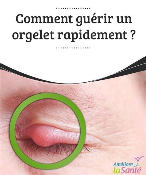 Comment guérir un orgelet rapidement ? Un #orgelet est bien #gênant et ...