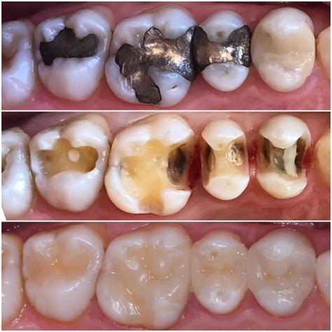 +29 Can Dentist Replace Amalgam Restorations With Composite 2023