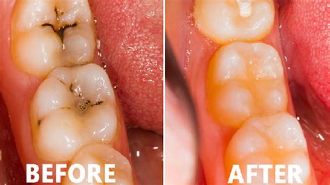 How to Reverse Tooth Decay? | 4 Tips To Reverse Tooth Decay Naturally