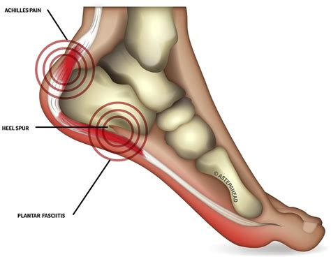 HEEL PAIN: CAUSES, TREATMENTS, AND HOW INSOLES CAN HELP – My Foot First | ubicaciondepersonas ...