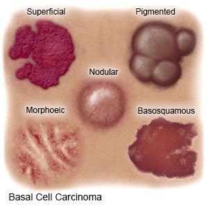 Basal Cell Carcinoma - What You Need to Know