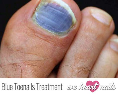 Bruised Blue Toenails? | Causes, Prevention & Treatments