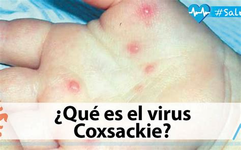 ¿Qué es el virus Coxsackie? - El Sol de Tampico | Noticias Locales, Policiacas, sobre México ...