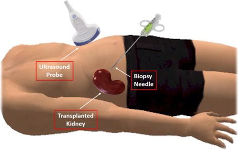 Renal Biopsy(allograft) treatment cost in Delhi| Renal Biopsy(allograft) treatment cost in India ...