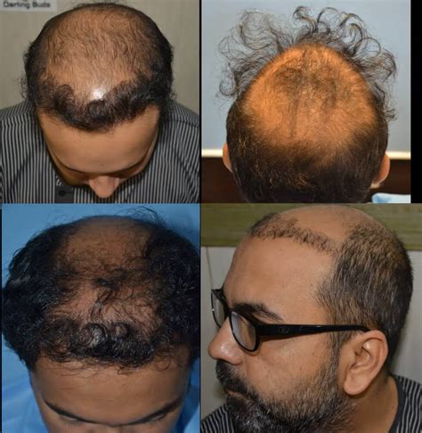 5 Reasons Why Hair Transplants Fail - What Is The Success Rate?