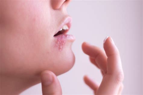 Can You Get Shingles Around Your Lips | Lipstutorial.org