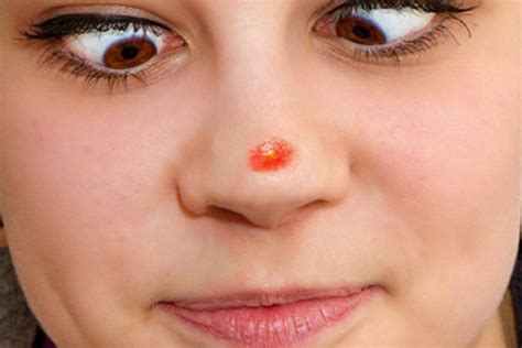 Pimple on Nose Causes, How to Get Rid of Big, Cystic Pimple on Nose ...