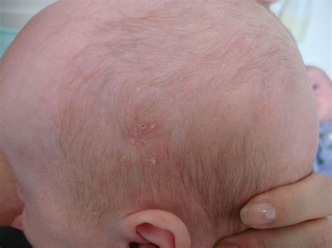 Langerhans Cell Histiocytosis Diaper Rash