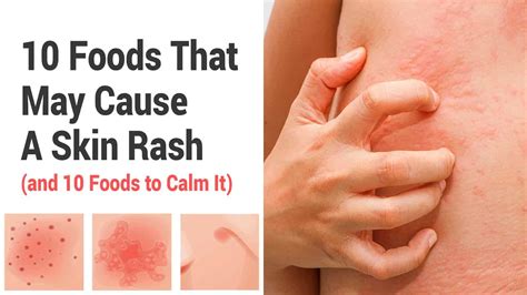 10 Foods That May Cause A Skin Rash (and 10 Foods to Calm It)