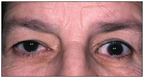 Thyroid eye disease | CMAJ