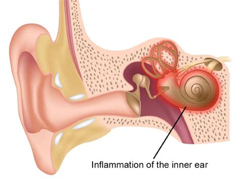 Autoimmune Inner Ear Disease: Symptoms, Causes, and Treatments | Harbor Audiology & Hearing Services