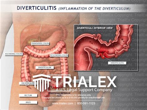 Anatomy of Sigmoid Colon Showing Diverticulitis - TrialQuest Inc.