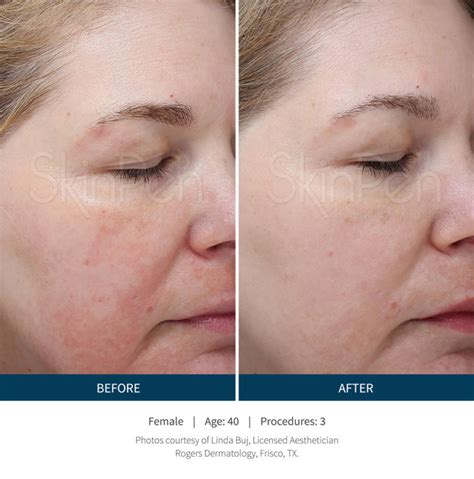 Microneedling Fresno | SkinPen | Mystique Medical Spa Freano