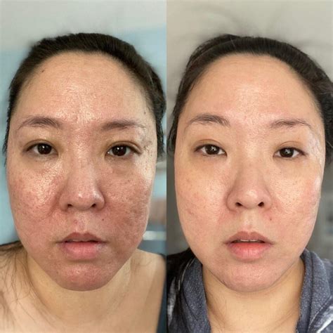 Face Before and After Vitamin C Serum: Astonishing Transformation Unveiled!