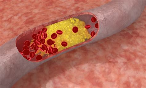 Triglycerides Test