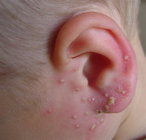 Folliculitis - Pictures, Types, Symptoms, Causes and Contagiousness