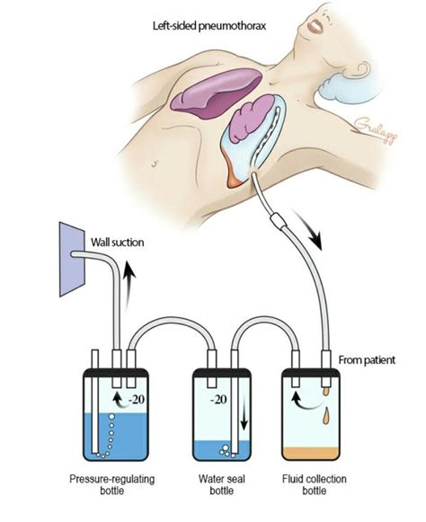 There are different types of chest tubes for different types of complications. | Chest tube ...