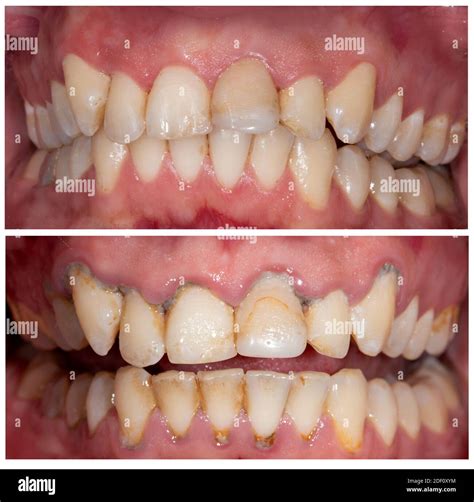 Perfect smile before and after bleaching procedure whitening of zircon ...