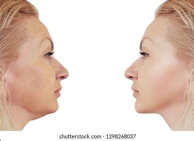 Woman Double Chin Before After Procedures Stock Photo 1298268037 | Shutterstock