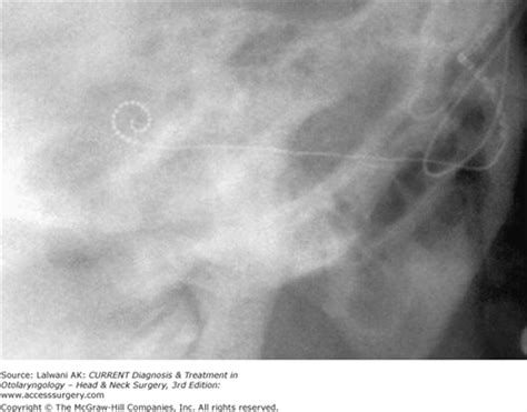 Implantable Middle Ear Hearing Devices | Ento Key