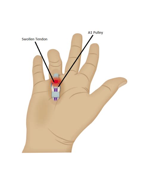 Trigger Finger Release | In2it Medical