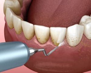 Newhall Dentist Improves Gum Health With A Deep Cleaning | Newhall, CA