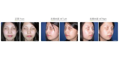 Nostril Exposure Correction-Nose | Wish Aesthetic Surgery Clinic