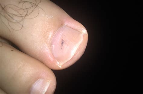 Melanoma under toenail pictures: black spot, nail melanoma pictures, toenail melanoma pictures ...