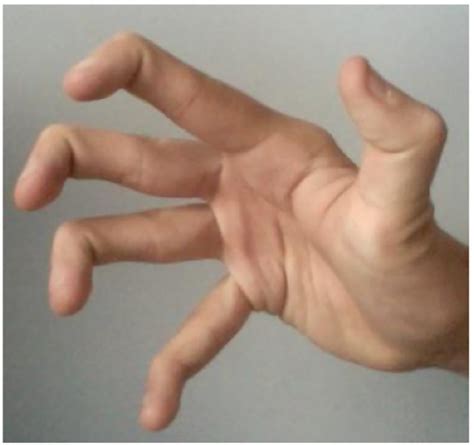 Hyper-flexibility at right hand (permission obtained from the patient). | Download Scientific ...