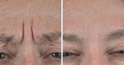 What Causes Lines Between Eyebrows - EyebrowShaper