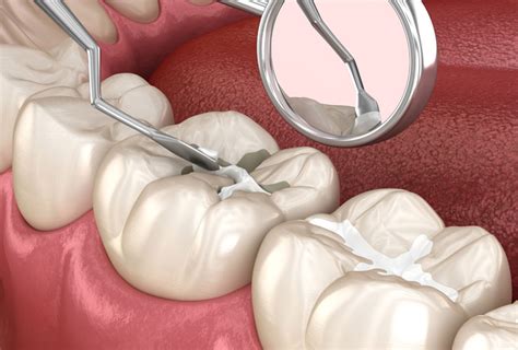 Fissure Sealants - Legends Dental