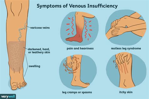 Vein Disorders - Humble, TX: Northeast Houston Vein Center