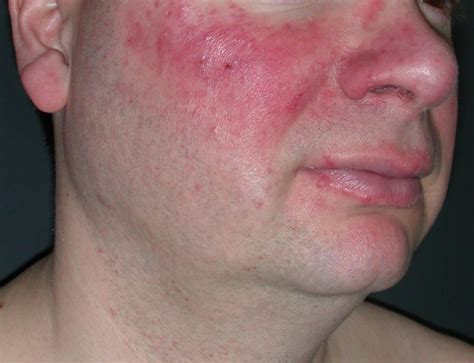 Oxymetazoline Effective for Long-Term Treatment of Rosacea-Associated ...