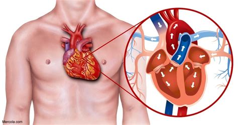 How is Heart Blockage Treated?