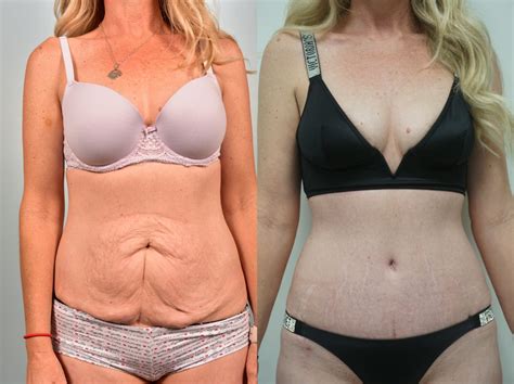 Tummy Tuck Before And After And The Average Cost - Fitoont