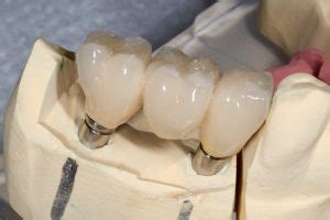 Everything You Need to Know About California Dental Implants - Call ...