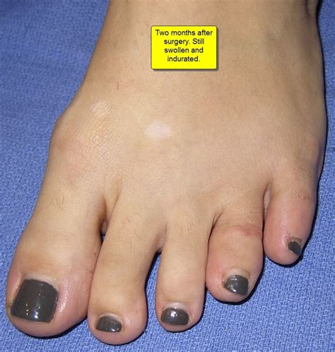 Part II: British Hammertoes are “Wonky Toes”! Before and After Pictures of Hammertoe Surgery ...