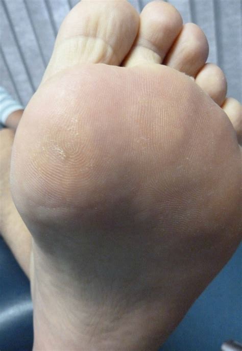 Plantar Wart Treatment | brightonpodiatry.com.au