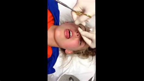 Tongue Stitches! - YouTube