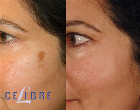 Sunspots On Face Treatment