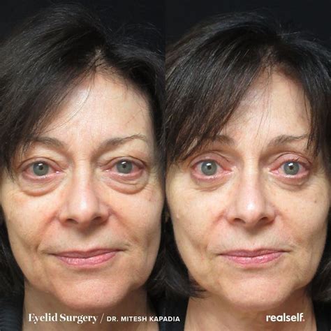 And do eye creams work? Eye Bag Surgery, Eyelid Surgery, Eye Bags Treatment, Face Treatment ...