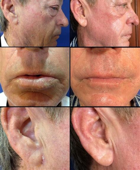 Erbium Laser Skin Resurfacing | Dr Monica Scheel Dermatology, Kailua-Kona, HI