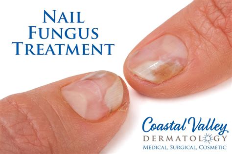 Hand Nail Fungus