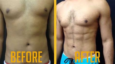 Vaser Hi-Def Liposuction Male Before/After Video - Advanced Lipo Centre - YouTube
