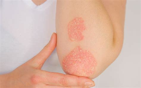 Is Psoriasis A Serious Skin Condition? Can It Be Treated? – SkinKraft