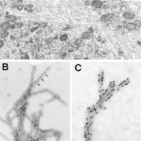 (PDF) Neurofibrillary Tangles and Alzheimer’s Disease