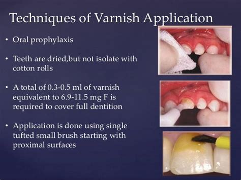 Dental Varnish