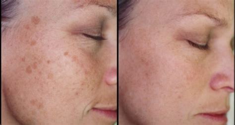 Remove Brown Spots From Your Skin With This Trick - HealthInaSecond.com