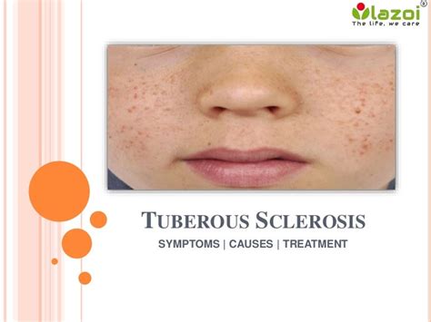 Tuberous Sclerosis : Causes, Symptoms, Diagnosis, Prevention and Trea…